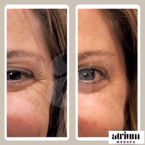 Before-and-after neurotoxin treatment of crow's feet.
