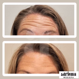 Before-and-after neurotoxin treatment of forehead lines.