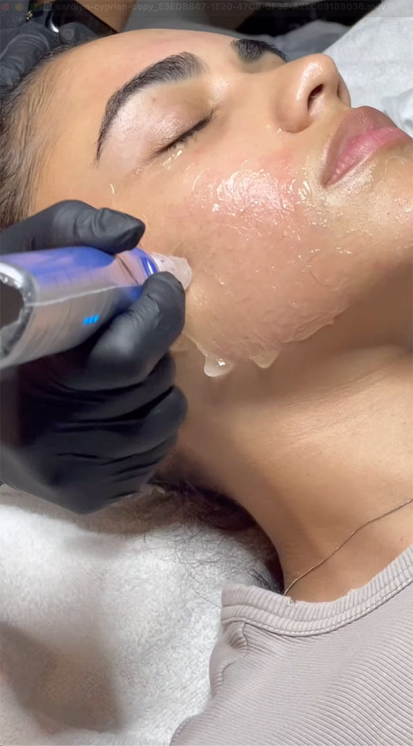 Microneedling and VI Peel Chemical Peel in Upper Saddle River, NJ 1 Skinpen treatment