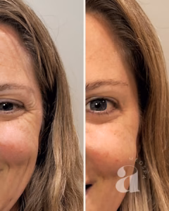 Before-and-after photos of a client treated for crow's feet with neurotoxin.