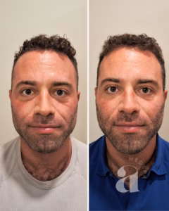 Before-and-after of full facial balancing in a male client.