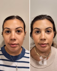 Before-and-after treatment with dermal filler.