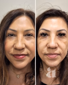 Before-and-after photo of facial balancing treatment.