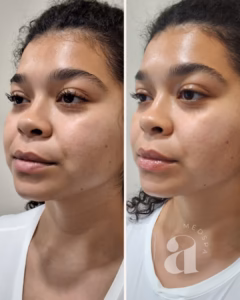 Before-and-after photo of a client receiving a sculpting facial.