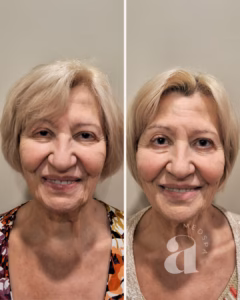 Before-and-after treatment with dermal filler.