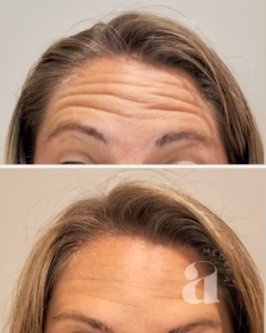 Before-and-after photos of a client treated with neurotoxin.
