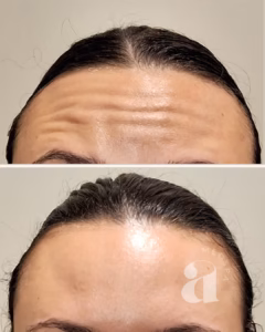 Before-and-after of forehead neurotoxin.