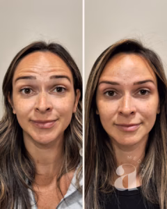 Before-and-after of forehead neurotoxin.