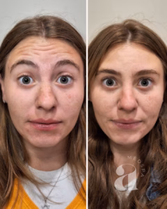 Before-and-after of forehead neurotoxin.