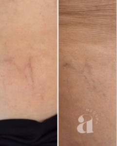 Before-and-after of single laser treatment of a leg vein.