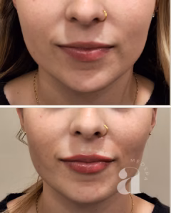 Before-and-after photos of lip filler treatment.