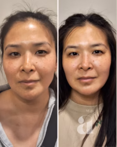Before-and-after photos of treatment with laser for benign pigmented lesions of the face.