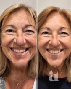 Before-and-after of ful-face neurotoxin treatment with dermal filler.