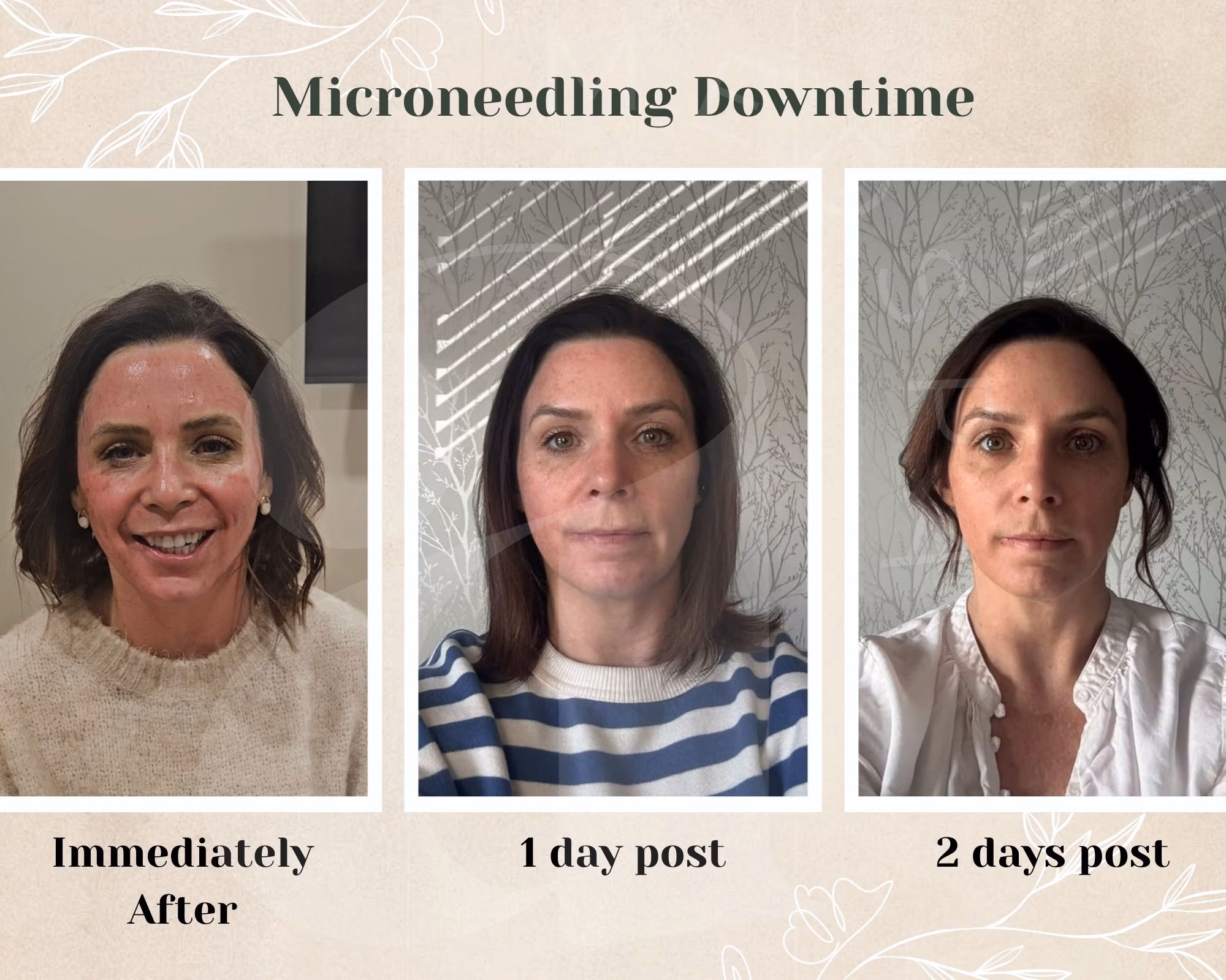 Become an Atrium Model 1 One of the first questions patients ask about any aesthetic treatment is, “How much downtime is there?”