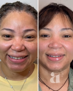 Before and after of a chemical peel treatment.
