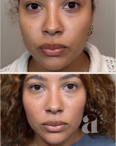 Before and after of a client who received Masseter Tox.