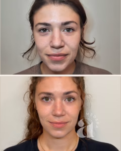 Before and after of a client who received Masseter Tox.