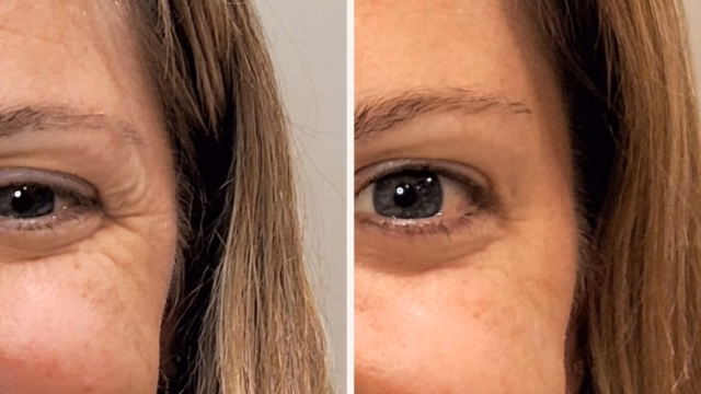Before-and-after tretment of Crow's Feet with neurotoxin. The wrinkles around the lateral eyes are significantly softened. Before-and-after photos of a client treated for crow's feet with neurotoxin.