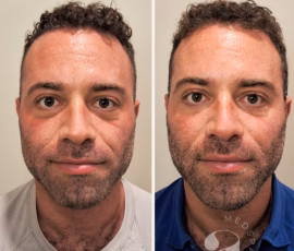 Before-and-after photo of filler treatment of the mid-face, undereye hollows, and chin. Before-and-after of full facial balancing in a male client.