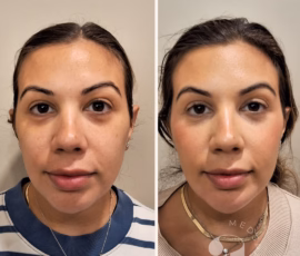 Before-and-after photo of facial balancing treatment. The cheekbones show additional support and the chin has a more chiseled appearance. Before-and-after treatment with dermal filler.