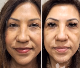Before-and-after photo of facial balancing treatment. The undereye regions look refreshed, the tissues over the cheekbones are more supported and volume loss at the jawline has been addressed. Before-and-after photo of facial balancing treatment.