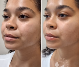 In addition to a visible glow, Atrium's sculpting & lymphatic drainage facial offers an immediate slimming effect that lasts up to several days. Before-and-after photo of a client receiving a sculpting facial.