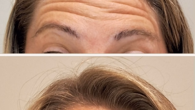 Before-and-after of forehead neurotoxin. Before-and-after photos of a client treated with neurotoxin.