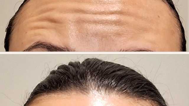 Before-and-after of forehead neurotoxin. Before-and-after of forehead neurotoxin.