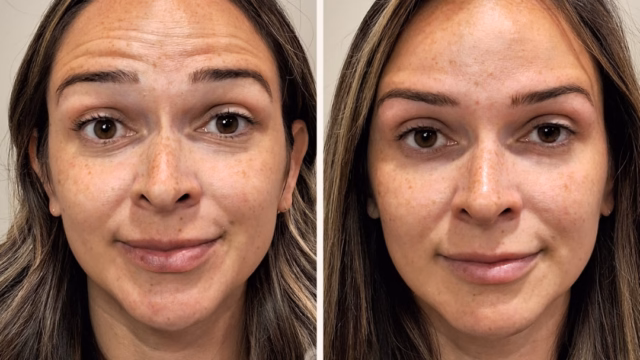 Before-and-after of forehead neurotoxin. Before-and-after of forehead neurotoxin.
