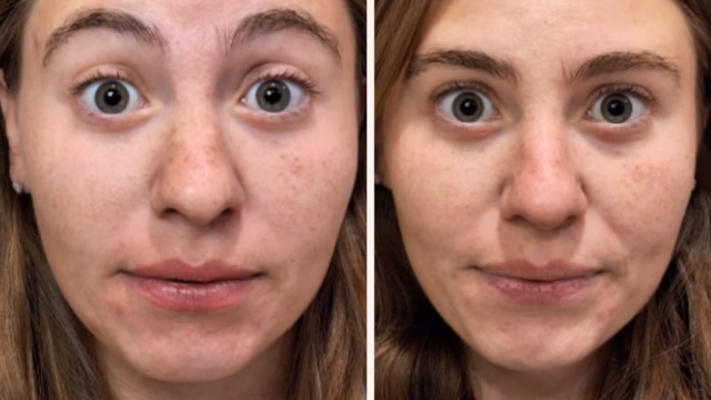 Before-and-after of forehead neurotoxin. Before-and-after of forehead neurotoxin.