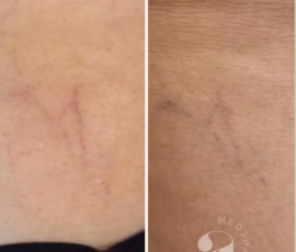 Before-and-after of leg vein treatment. Results pictured are after a single treatment. Before-and-after of single laser treatment of a leg vein.