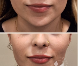 Before-and-after photos of lip filler treatment. The lips look more plump, hydrated, and the "cupids bow" of the middle of the upper lip is more defined, while still maintaining a natural, not-overdone look. Before-and-after photos of lip filler treatment.