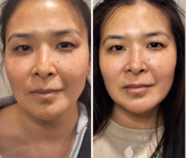 Before-and-after treatment of pigmented lesion of the face. The had spot treatment performed of the freckles under her right eye (left side of photos). Before-and-after photos of treatment with laser for benign pigmented lesions of the face.