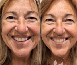 Before-and-after of full face neurotoxin and dermal filler. The forehead lines, bunny lines, crows' feet, jowls and platysmal bands are all significantly softened, giving her a refreshed, more youthful appearance. Before-and-after of ful-face neurotoxin treatment with dermal filler.