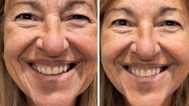 Before-and-after of full face neurotoxin and dermal filler. The forehead lines, bunny lines, crows' feet, jowls and platysmal bands are all significantly softened, giving her a refreshed, more youthful appearance. Before-and-after of full face neurotoxin and dermal filler.