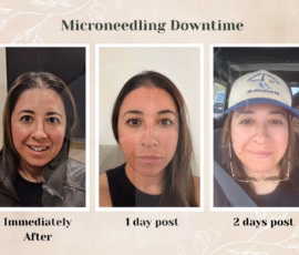 The microneedling downtime journey typically only lasts a few days. Depiction of microneedling downtime length