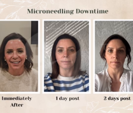 The microneedling downtime journey typically only lasts a few days. Depiction of microneedling downtime length